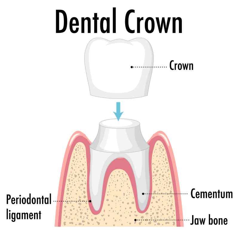 annotated diagram of a dental crown, highlighting its components: 1. Crown, 2. Periodontal Ligament, 3. Cementum, and adjacent jaw bone.