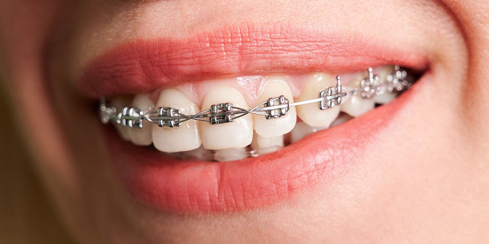 What should i do if braces wire came out