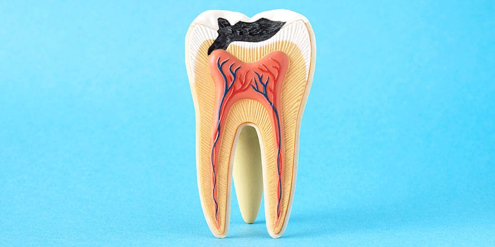 Dead tooth after root canal