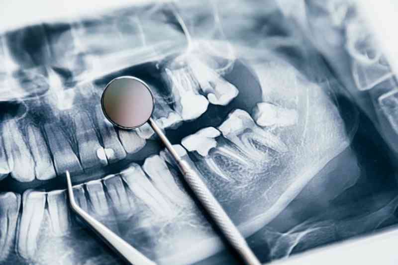 How will my bone be impacted after a tooth extraction?