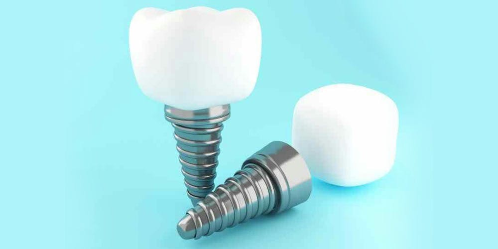 Reasons Why Dental Implants Are Not Integrated