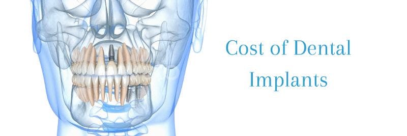 How Much Dental Implants Cost