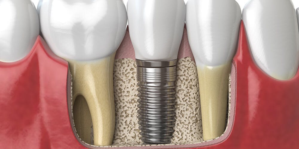 How to do dental implant place