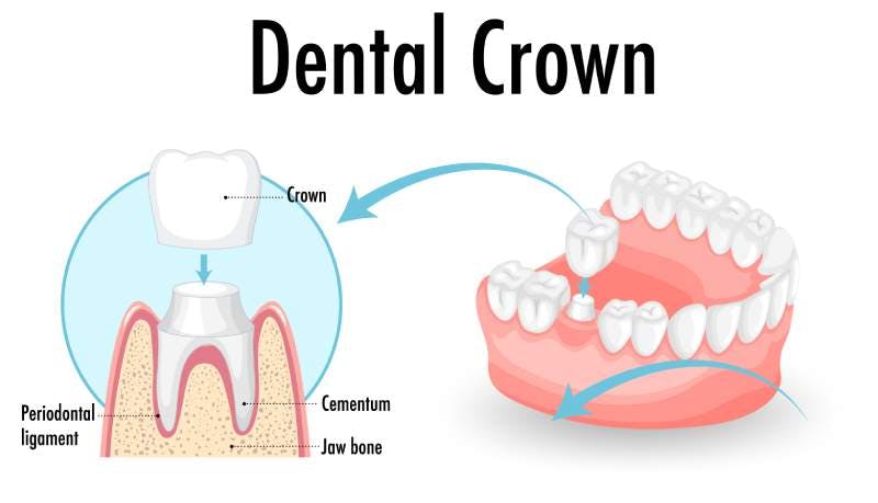 The Importance of Tooth Crowns and Why You Need Them